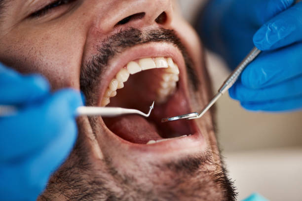 Best Emergency Wisdom Teeth Removal in Houston, TX